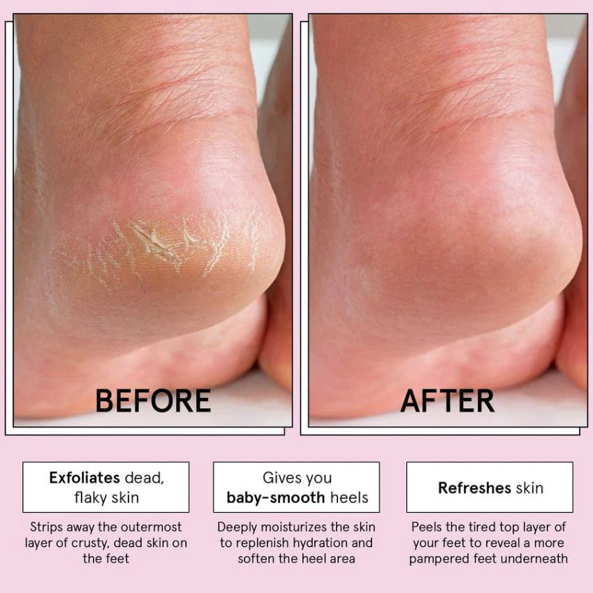 exfoliating foot peel mask